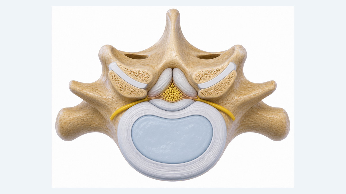 Estenosi de canal lumbar