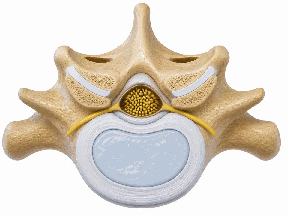 Imatge d'estenosi de canal lumbar